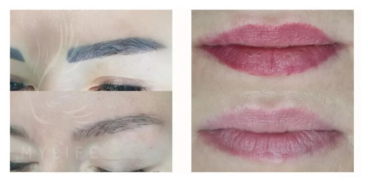 Видалення татуажу — сучасні методи, безпечні технології та відновлення природності